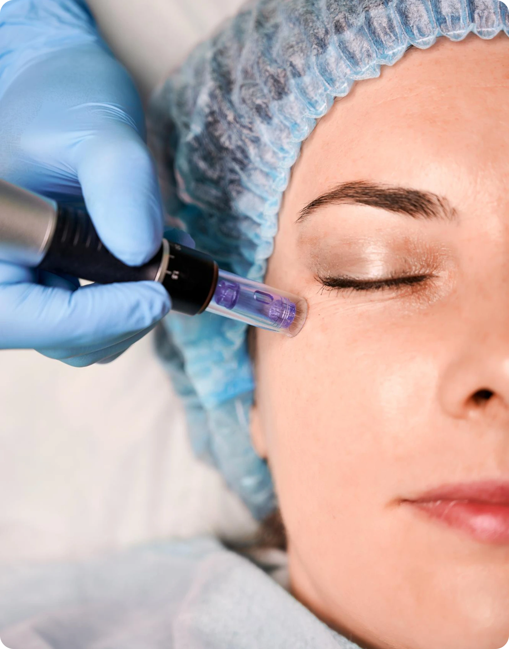 SkinPen Microneedling Procedure