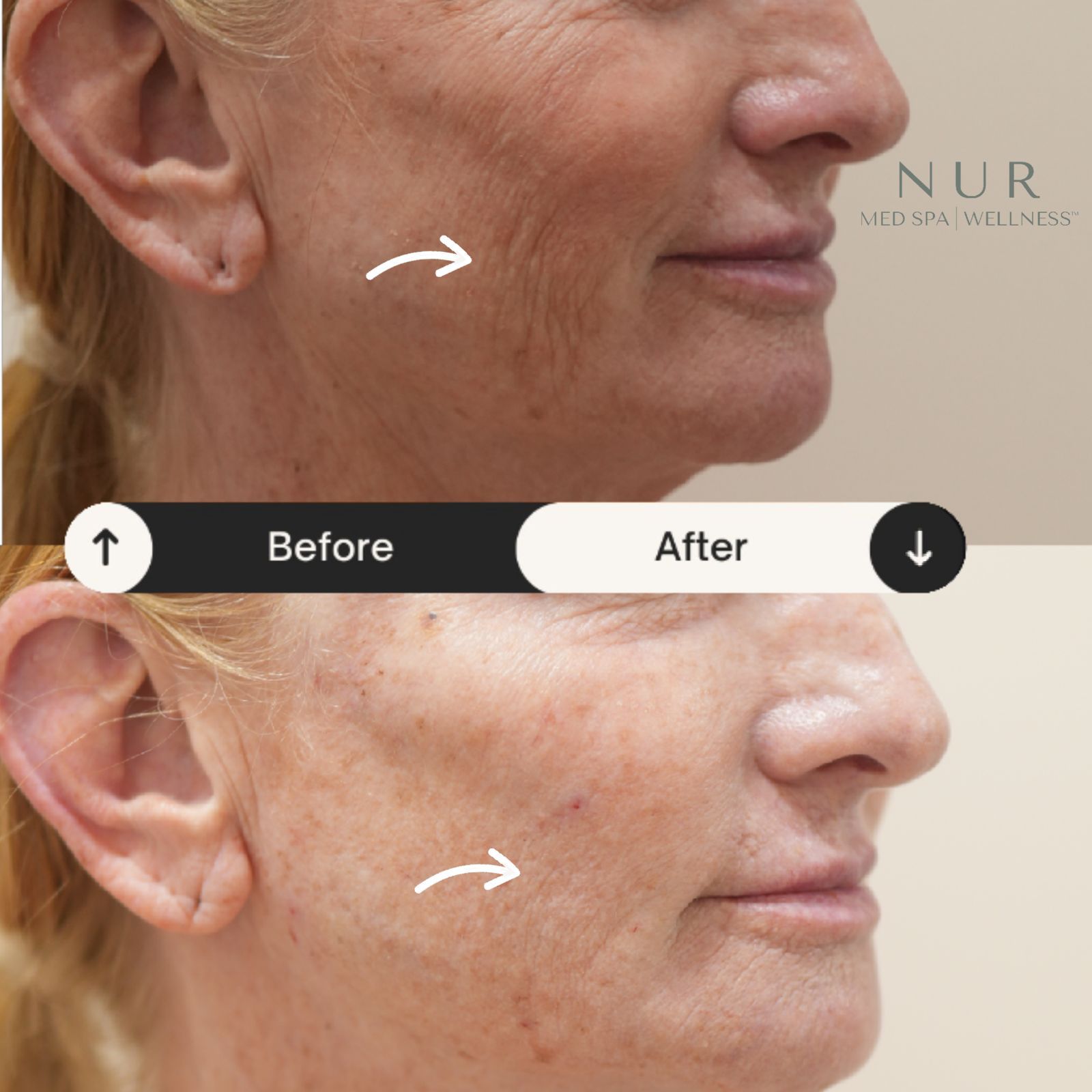  Derma prp