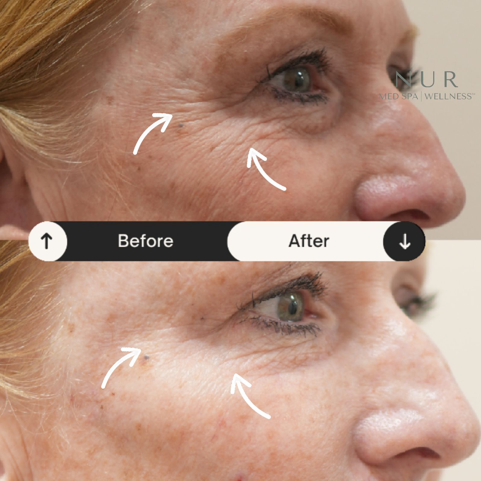  Derma prp