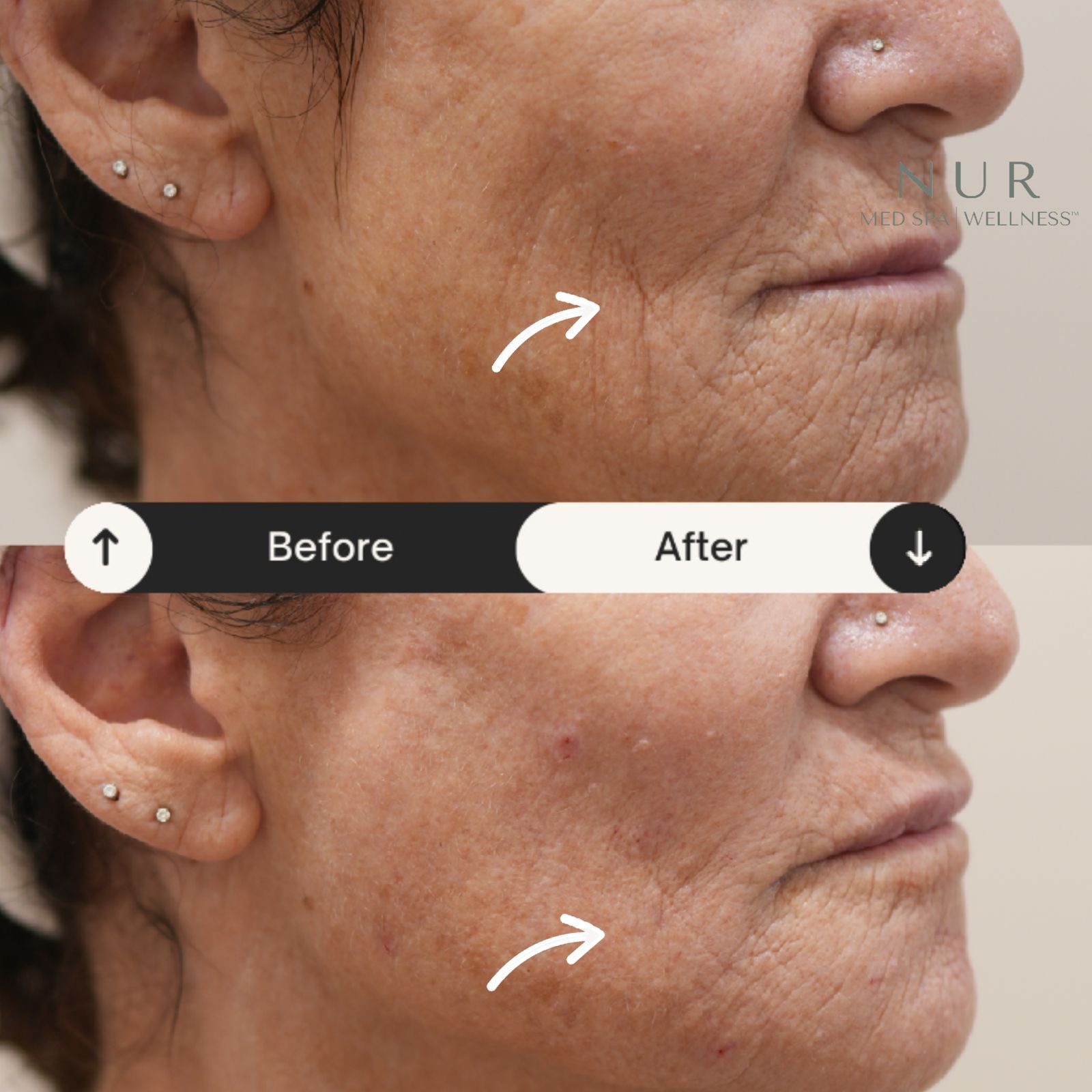  Derma prp