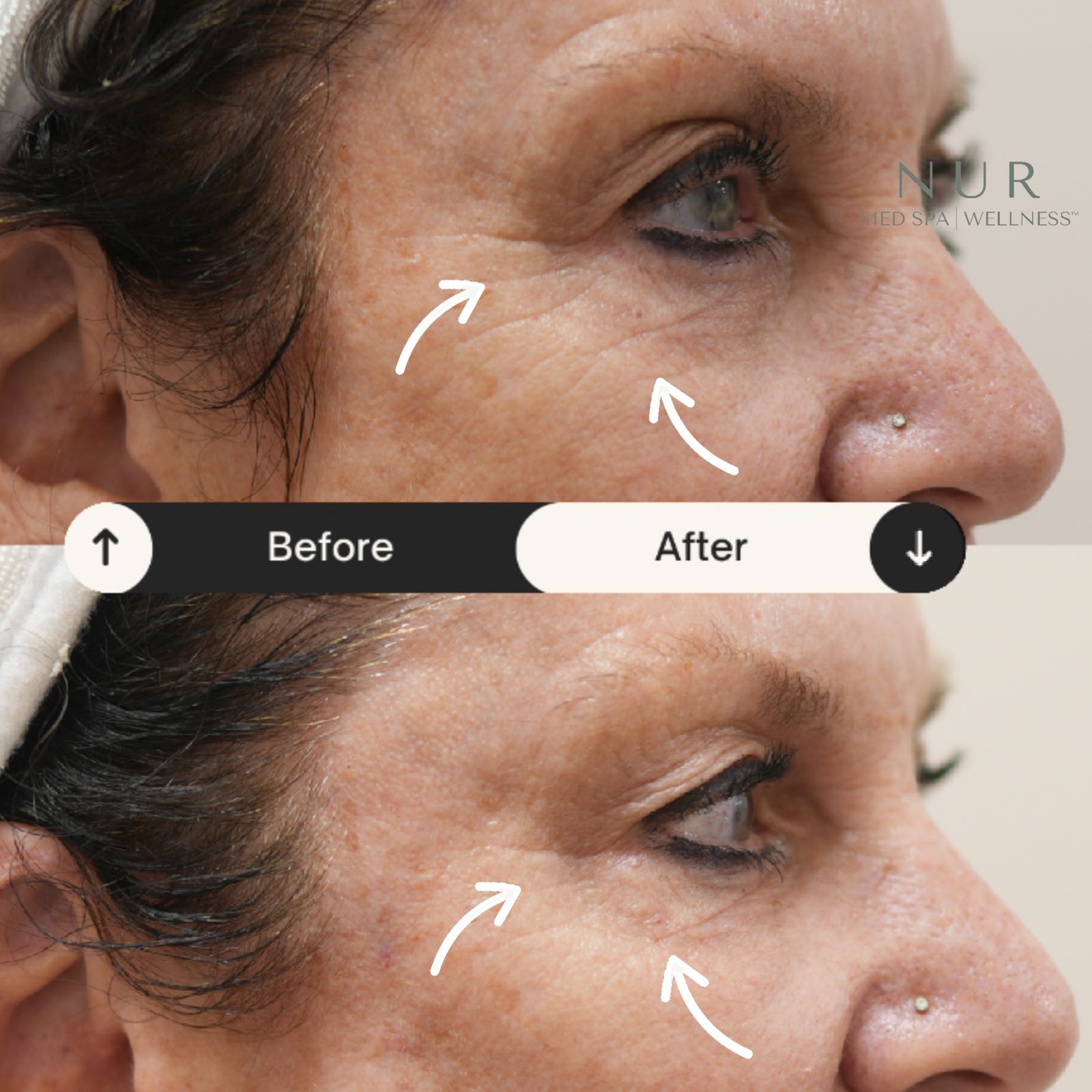  Derma prp