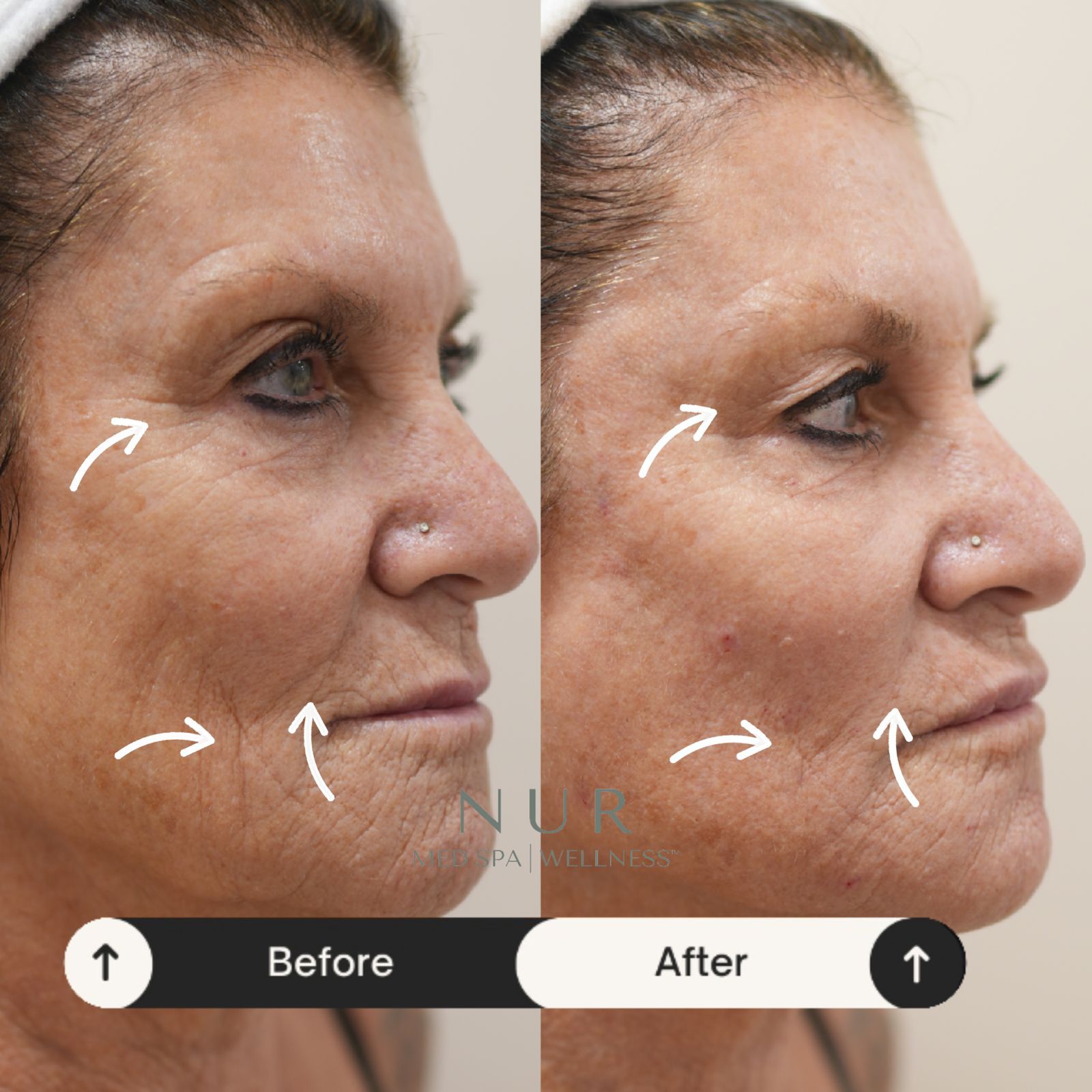  Derma prp