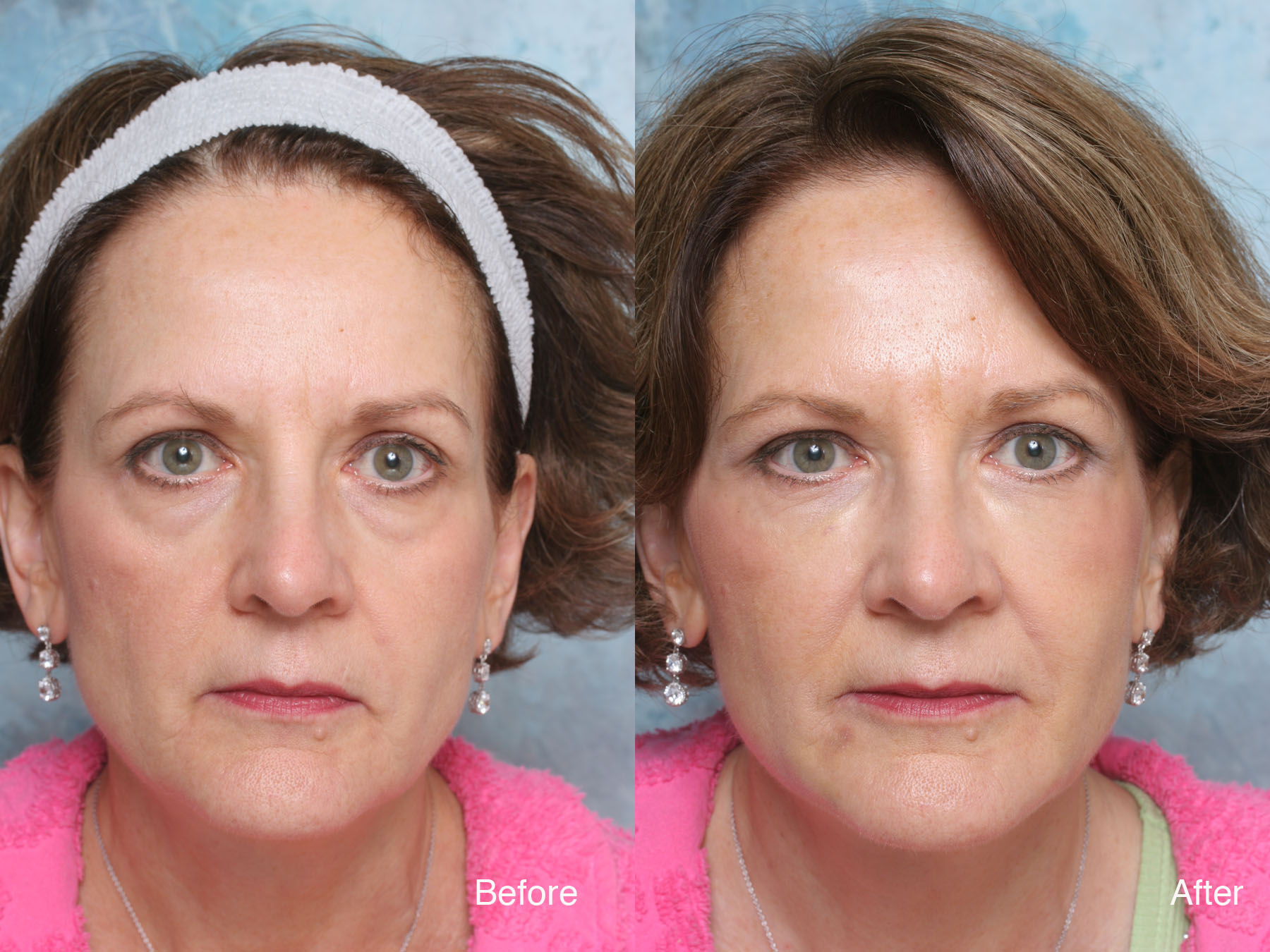 UNDEREYES