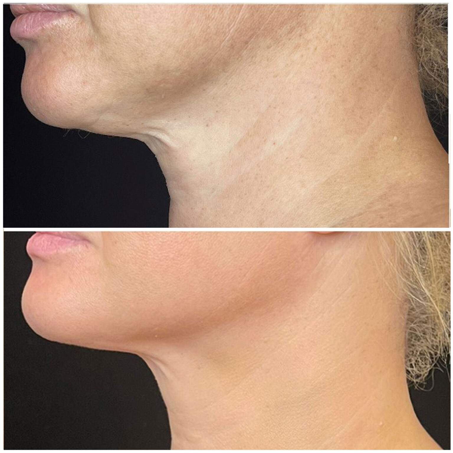 NECK