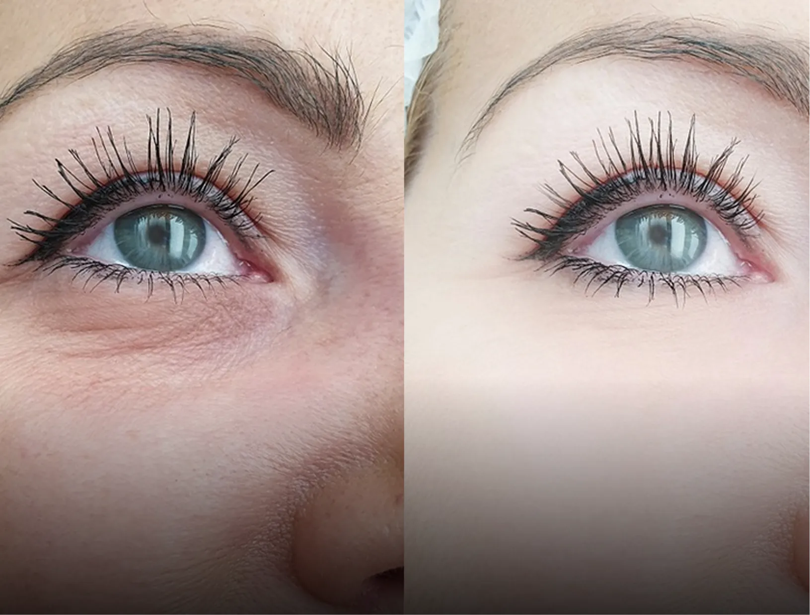 Crow's Feet before and after