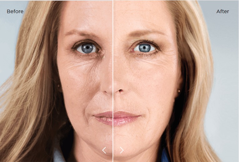 Biostimulators Sculptra & Radiesse at NUR Med Spa