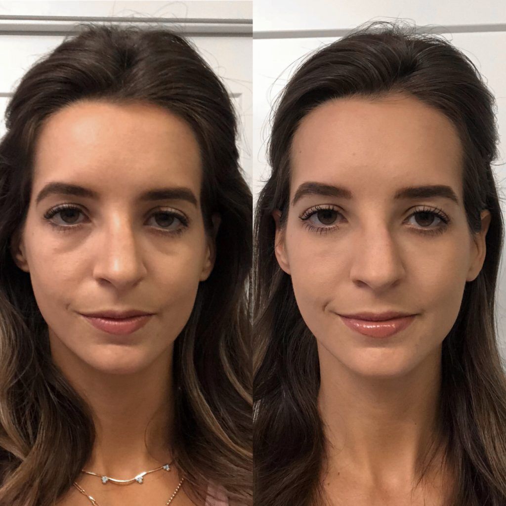 UNDEREYES