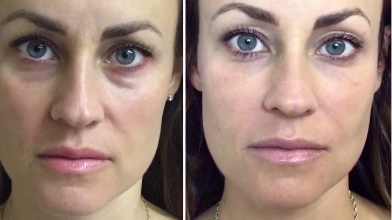UNDEREYES