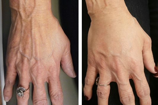 HANDS