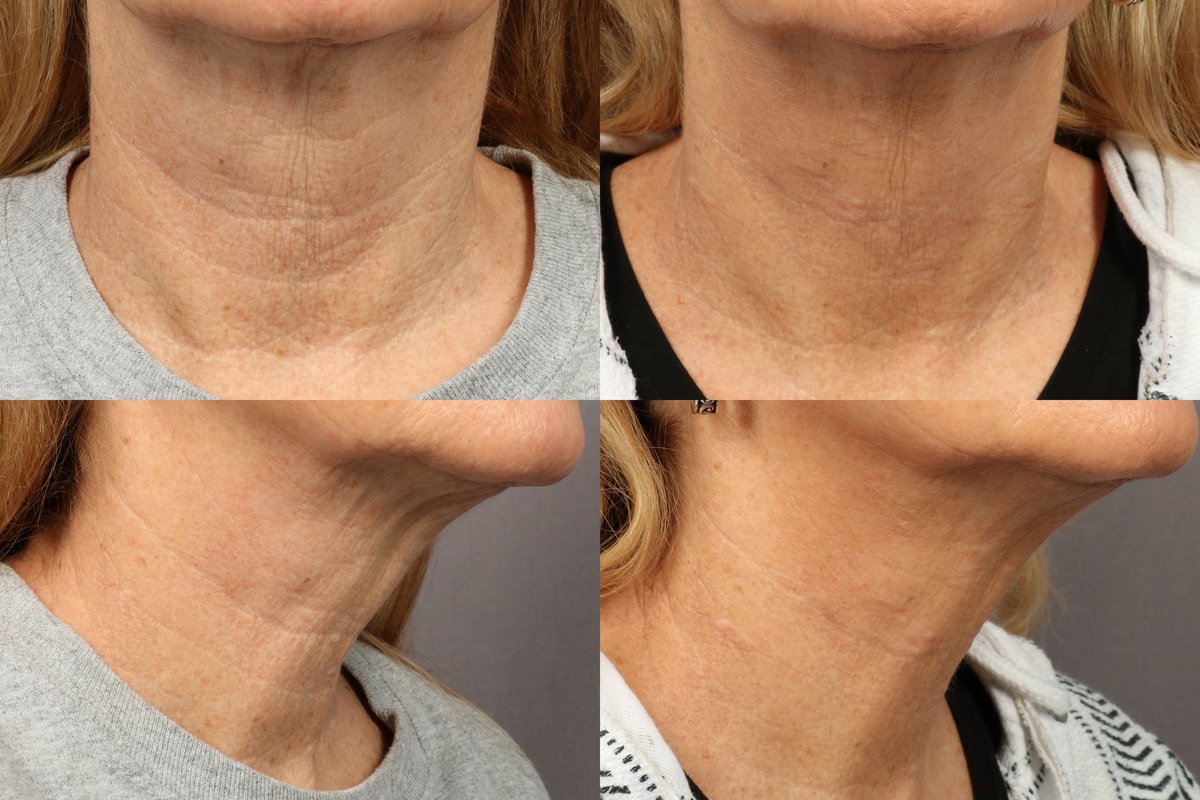 NECK LINES