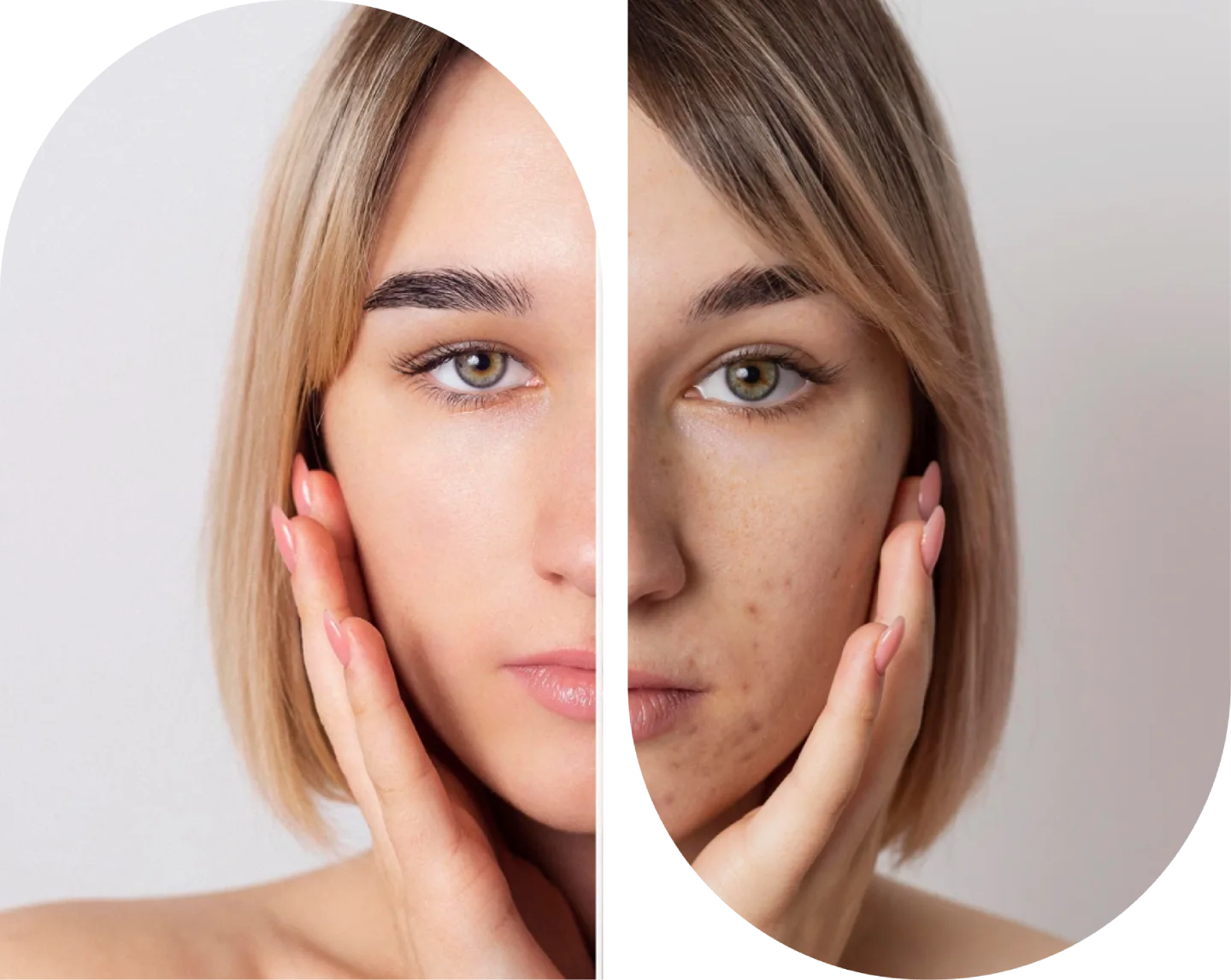 Active Acne