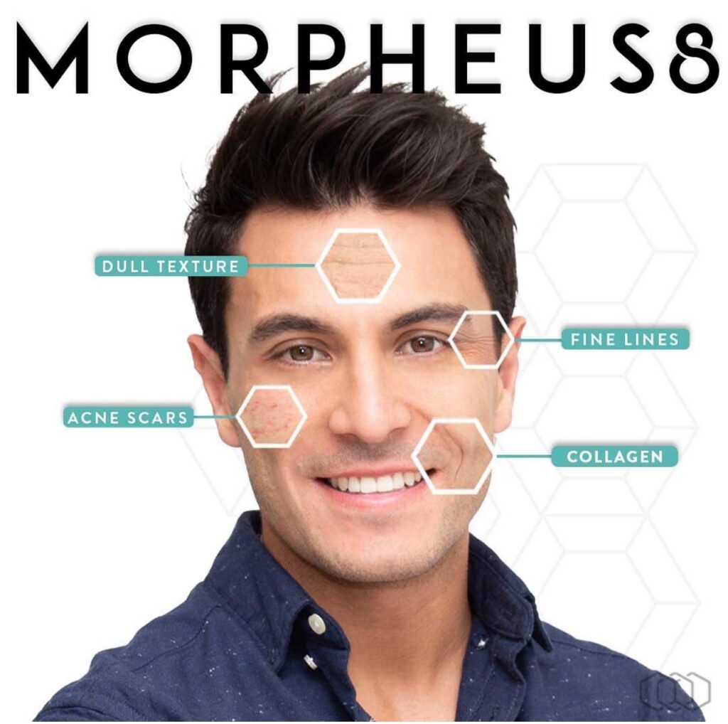 Morpheus8 Non-Surgical Skin Tightening Treatment in Altamonte Springs