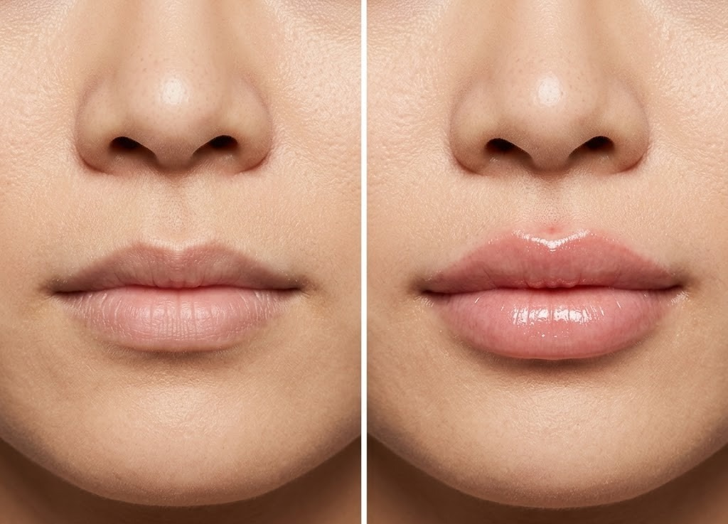 lip flip vs lip filler