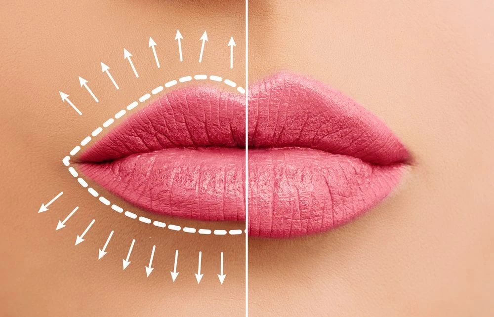 Do’s and Don’ts After Lip Filler Injections To Help You Heal
