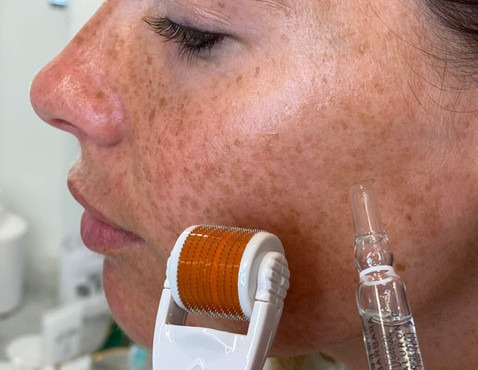 Microneedling treatment being performed