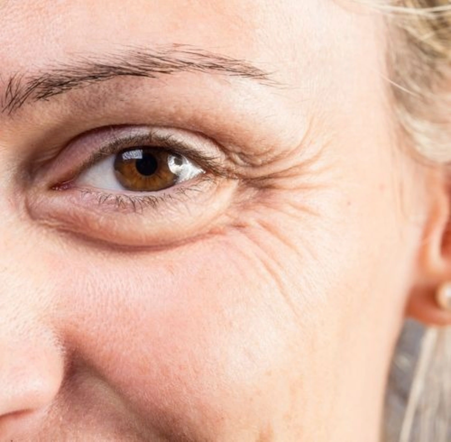 Guide on crow’s feet cause, prevention and treatment