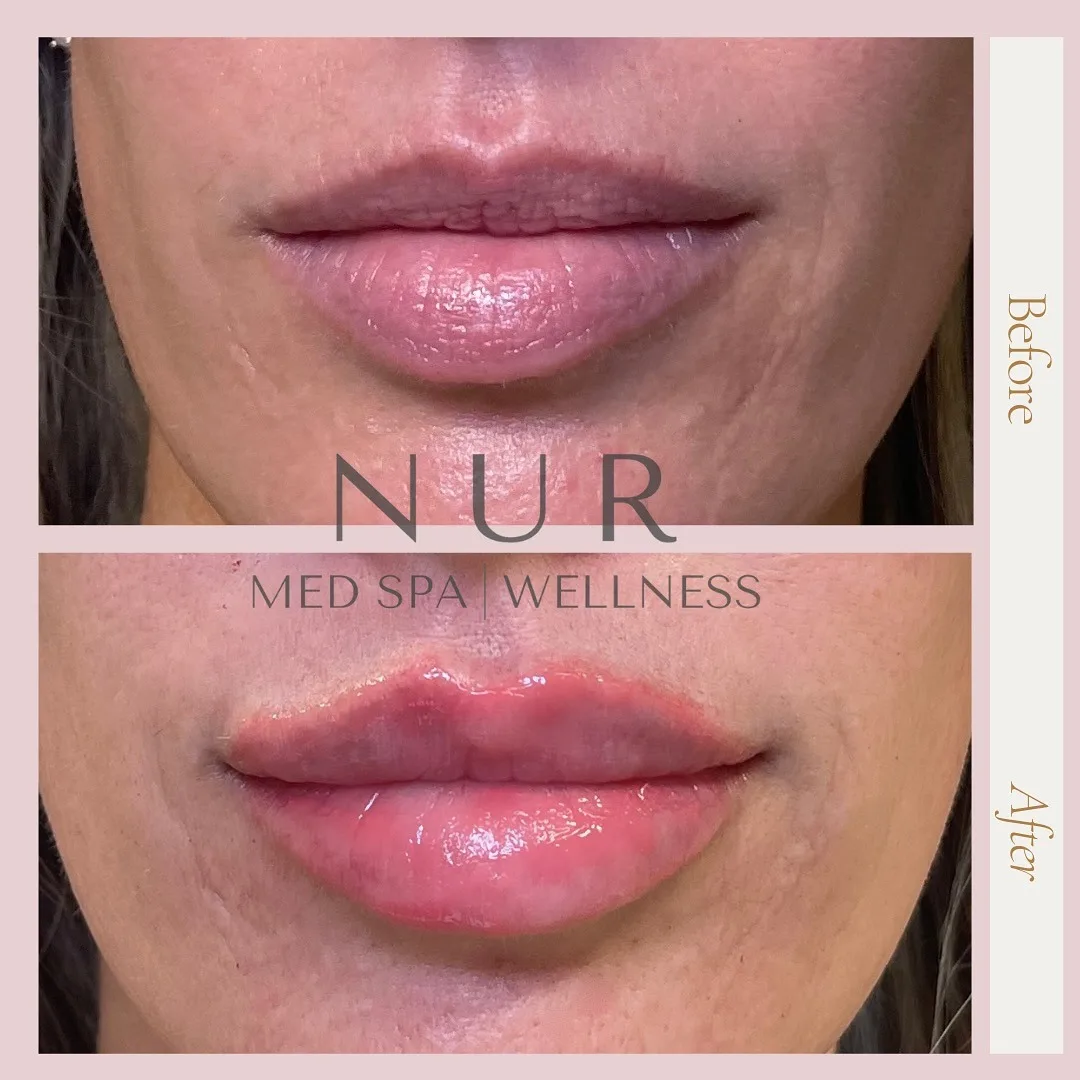 lip filler treatment