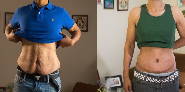 how to get rid of loose skin after weight loss