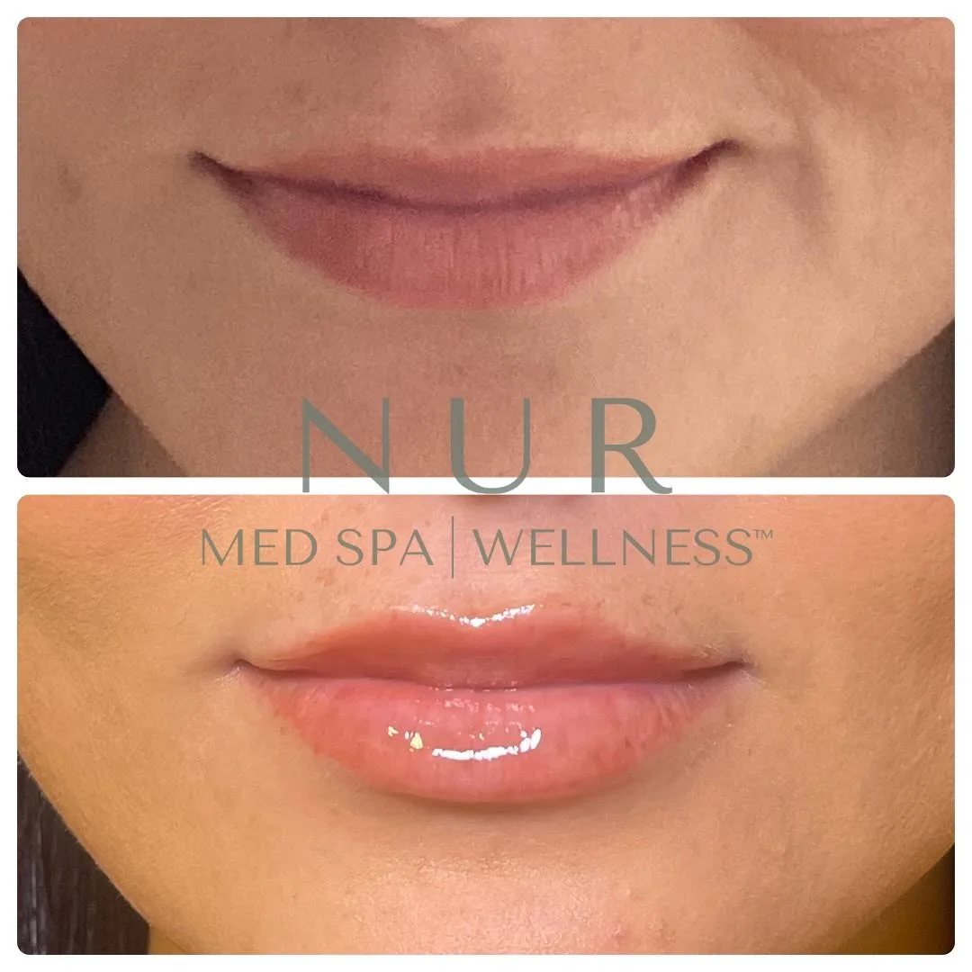 Natural looking lips after filler
