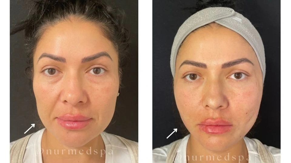 Botox results in different areas of the face