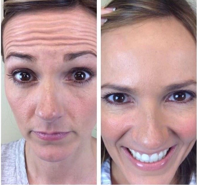 Before and after Botox for forehead lines