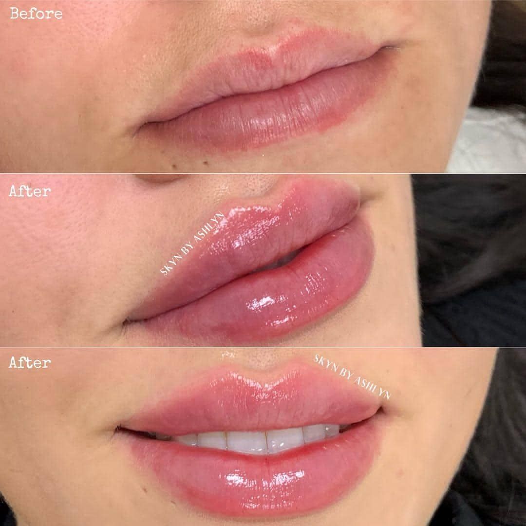 LIPS