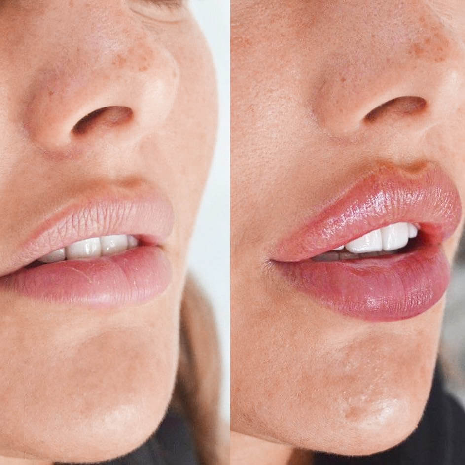 LIPS